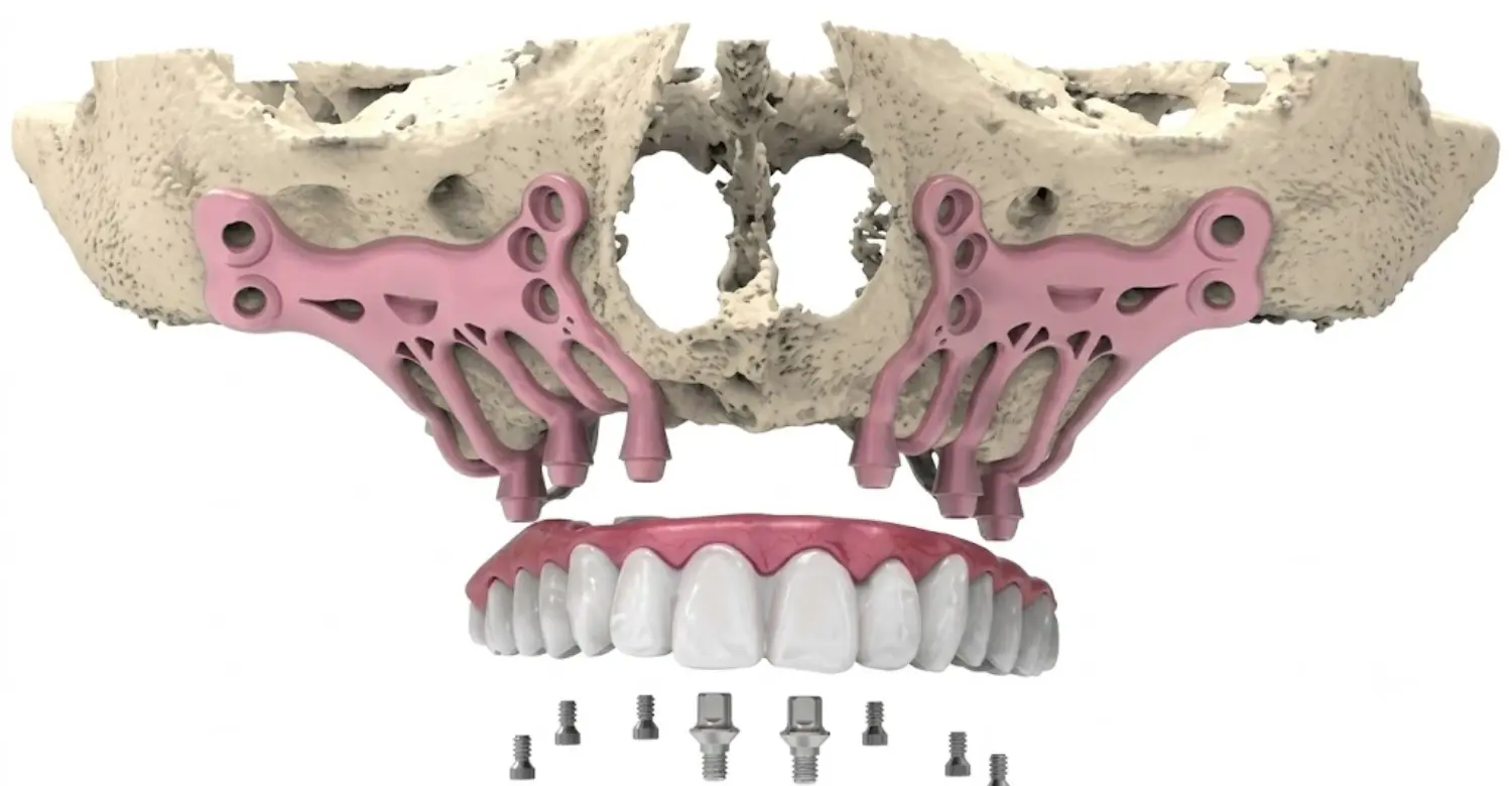 subperiosteal implant care 2